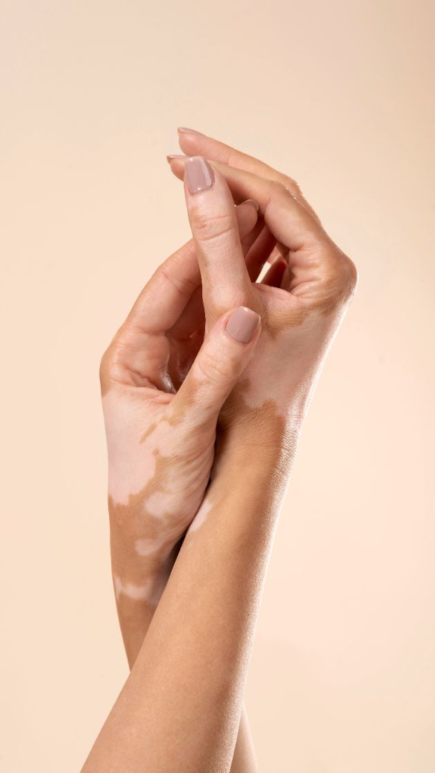 vitiligo-kako-da-go-prepoznaete-i-tretirate-10.jpg