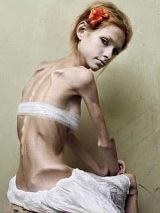 anoreksija-na-delo-ovaa-devojka-ima-samo-25-kg-6