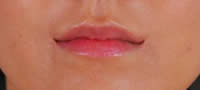 nov-trend-vo-plasticnite-operacii-joker-nasmevka-video-povekje