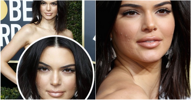 kendall-jenner-odblisku-so-akni-po-liceto-na-crven-tepih-001.jpg