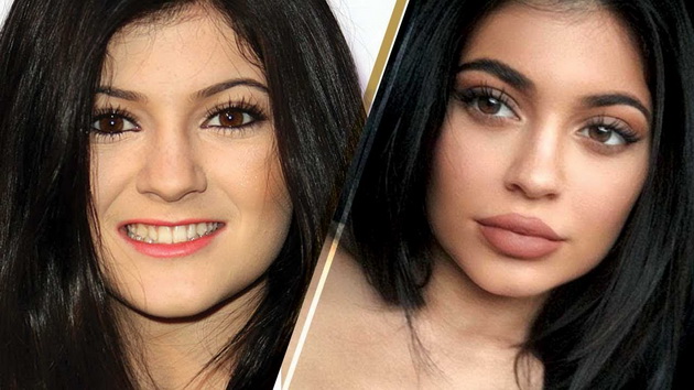 kylie-jenner-gi-izvadi-filerite-konecno-lici-na-20godisna-devojka-3-8.jpg