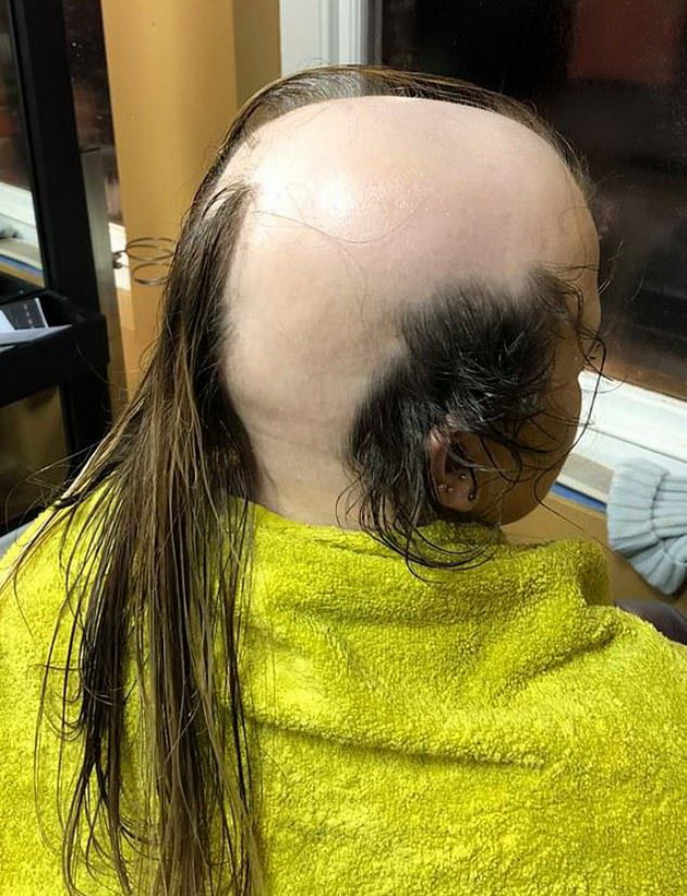 devojka-shto-strada-od-alopecija-od-16-godini-hrabro-ja-izbrichi-glavata-05.jpg