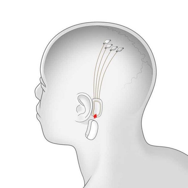 ilon-mask-go-pretstavi-mozochniot-implant-so-kojshto-kje-mozhete-da-ja-kontrolirate-tehnologijata-03.jpg