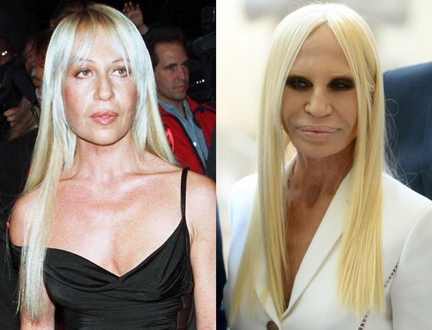 kako-izgledase-donatela-versace-pred-da-se-unisti-so-plasticni-operacii-02.jpg