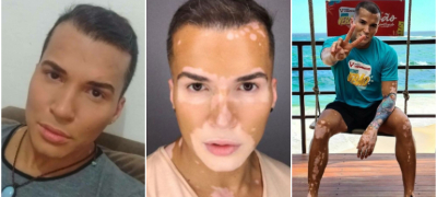 model-so-vitiligo-10-godini-go-kriel-liceto-so-shminka-sega-gi-ohrabruva-site-da-se-prifatat-so-svojata-unikatnost-povekje.jpg