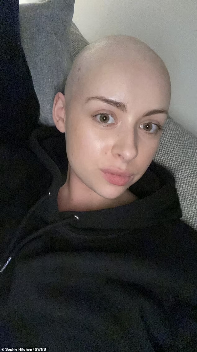24-godishna-devojka-ja-izgubila-celata-kosa-za-6-nedeli-sega-im-e-inspiracija-na-lugjeto-so-alopecija-02.jpg