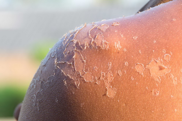 dermatolog-spodeluva-soveti-za-crnobelo-com-zaboravete-na-kiselo-mleko-za-izgorena-kozha-i-kantarionovo-maslo-za-potemnuvanje-06.jpg
