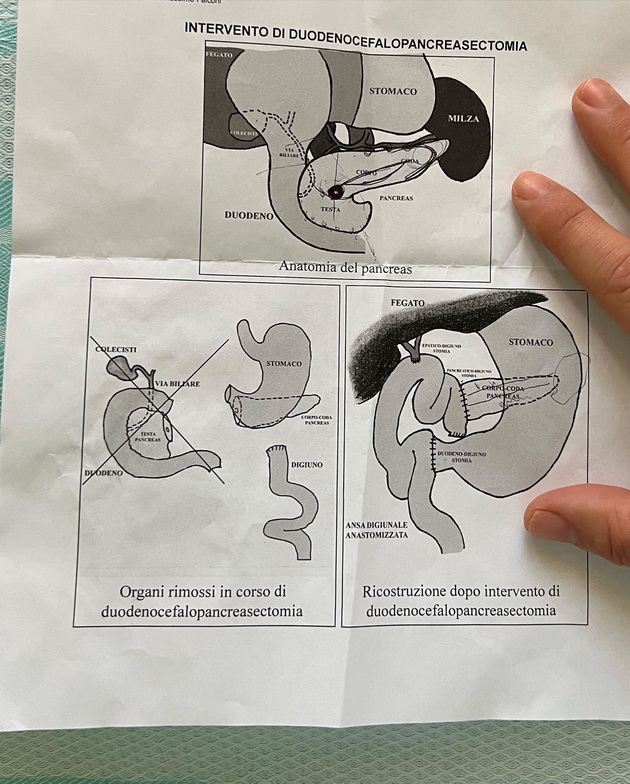 soprugot-na-italijankata-kjara-feranji-mi-dijagnosticiraa-nevroendokrin-tumor-imav-operacija-od-6-chasa-mi-otstranija-del-od-pankreasot-06.jpg