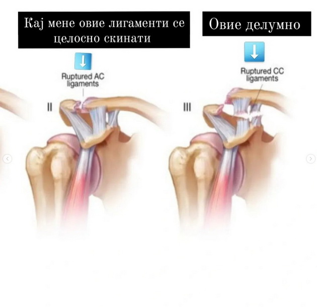 doktor-goran-gi-skinav-ligamentite-mi-se-odlepi-kluchnata-koska-od-lopatkata-mi-stana-crno-pred-ochite-02.jpg