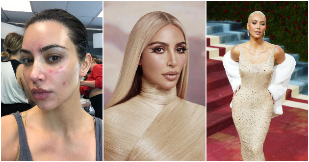 kim-kardashijan-za-ekstremnata-dieta-dobiv-psorijaza-po-celoto-telo-ne-mozhev-da-gi-mrdam-racete-no-kje-napravam-s-za-da-bidam-ubava-01.jpg