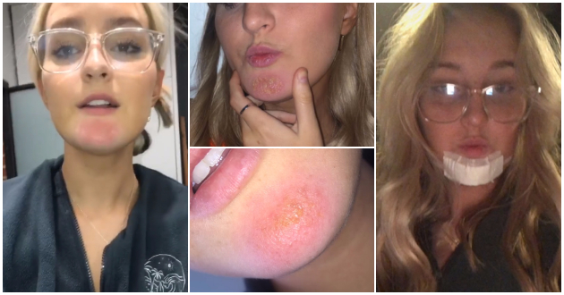 dobiv-infekcija-od-bradata-na-dechko-mi-po-baknuvanjeto-so-nego-morav-da-primam-antibiotici-video-01.jpg