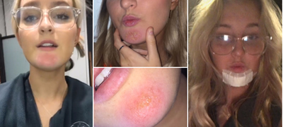 dobiv-infekcija-od-bradata-na-dechko-mi-po-baknuvanjeto-so-nego-morav-da-primam-antibiotici-video-povekje-01.jpg