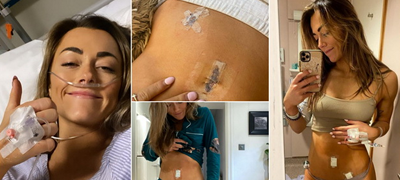 influenserka-pokazhuva-odblizu-kako-izgledaat-dupki-na-stomak-po-laparoskopija-mi-vmetnaa-kamera-preku-papokot-01povekje.fw.png