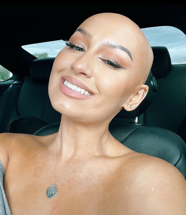 imam-alopecija-od-bebe-na-6-godini-ja-izbrichiv-glavata-a-na-14-gi-izgubiv-vegjite-i-trepkite-08.jpg