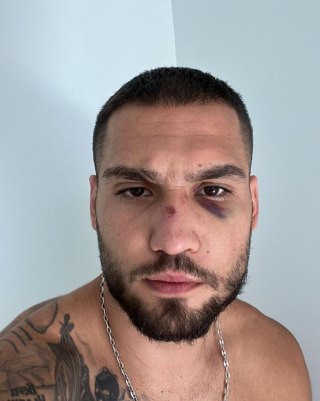 makedonski-profesionalen-bokser-gi-pokazhuva-povredite-po-natprevarite-ova-e-cenata-na-uspehot-05.jpg