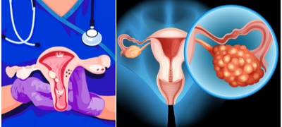 Симптоми, ризични фактори: Работи што секоја жена мора да ги знае за ракот на јајници