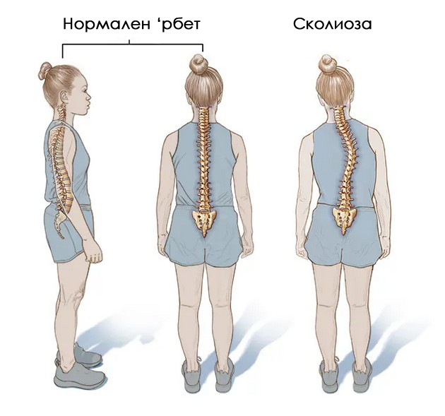 koi-se-prichinite-za-pojava-na-skolioza-i-mozhe-li-da-se-sprechi-04.jpg