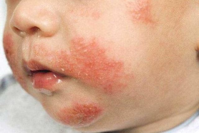 atopicen-dermatit-kaj-bebinja-pricini-poradi-koi-se-javuva-i-kako-da-go-lekuvate-03.jpg