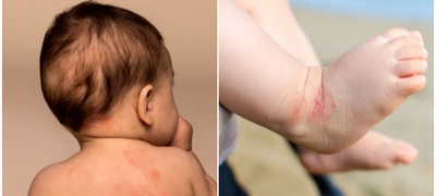 atopicen-dermatit-kaj-bebinja-pricini-poradi-koi-se-javuva-i-kako-da-go-lekuvate-povekje.jpg
