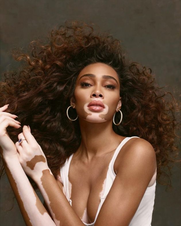 vitiligo-kako-da-go-prepoznaete-i-tretirate-02.jpg