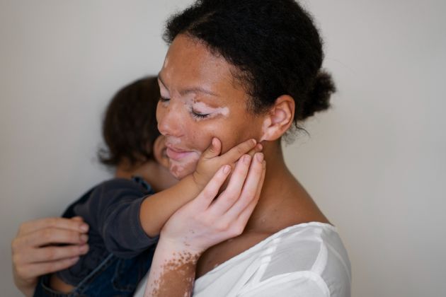 vitiligo-kako-da-go-prepoznaete-i-tretirate-04.jpg