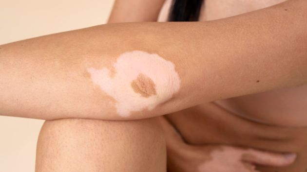 vitiligo-kako-da-go-prepoznaete-i-tretirate-07.jpg