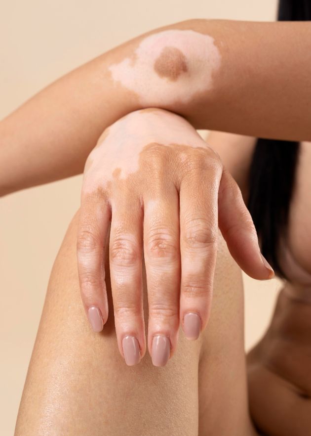 vitiligo-kako-da-go-prepoznaete-i-tretirate-08.jpg
