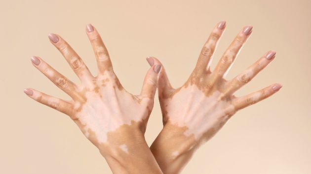 vitiligo-kako-da-go-prepoznaete-i-tretirate-09.jpg