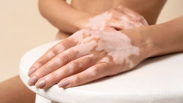vitiligo-kako-da-go-prepoznaete-i-tretirate-11.jpg
