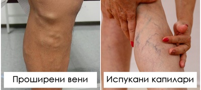 koja-e-razlikata-pomegju-ispukani-kapilari-i-proshireni-veni-i-dali-se-opasni-povekje.jpg