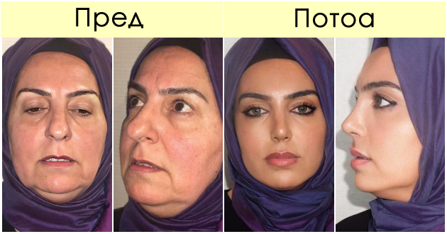 ne-e-vozmozhno-da-e-istata-zhena-turski-plastichen-hirurg-objavi-fotka-od-neverojatna-transformacija-i-predizvika-lavina-reakcii-01.jpg