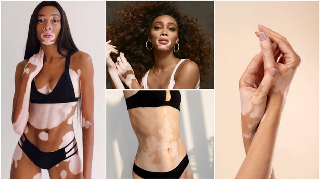 vitiligo-kako-da-go-prepoznaete-i-tretirate-01.jpg