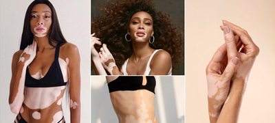 vitiligo-kako-da-go-prepoznaete-i-tretirate-01povekje.jpg