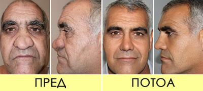 drastichna-promena-po-estetska-operacija-turchin-se-transformirashe-vo-dzordz-kluni-povekje-01.jpg
