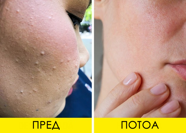 zoshto-se-javuvaat-beli-tochki-na-liceto-i-kako-da-gi-otstranite-03.jpg