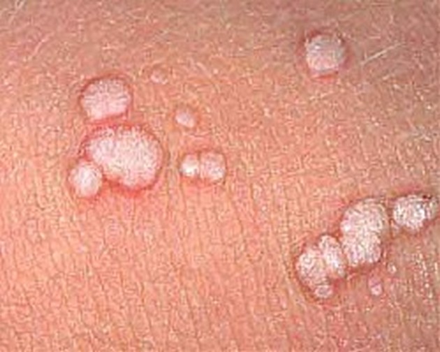 prof-d-r-vasil-iliev-hpv-virusot-obichno-nema-simptomi-najefikasna-prevencija-e-vakcina-treba-da-se-vakciniraat-i-momchinja-03.JPG