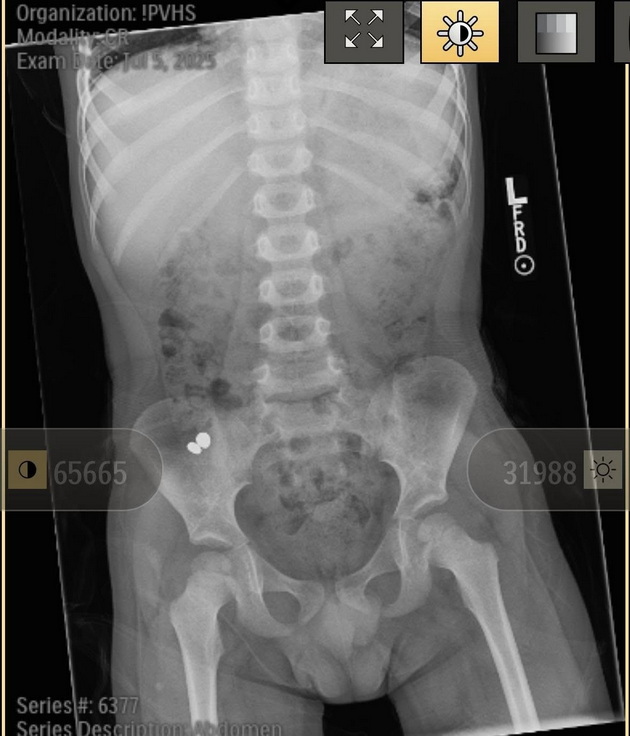 sin-mi-lapnal-dva-magneta-zavrshivme-na-urgentno-koja-beshe-opasnosta-06.jpg