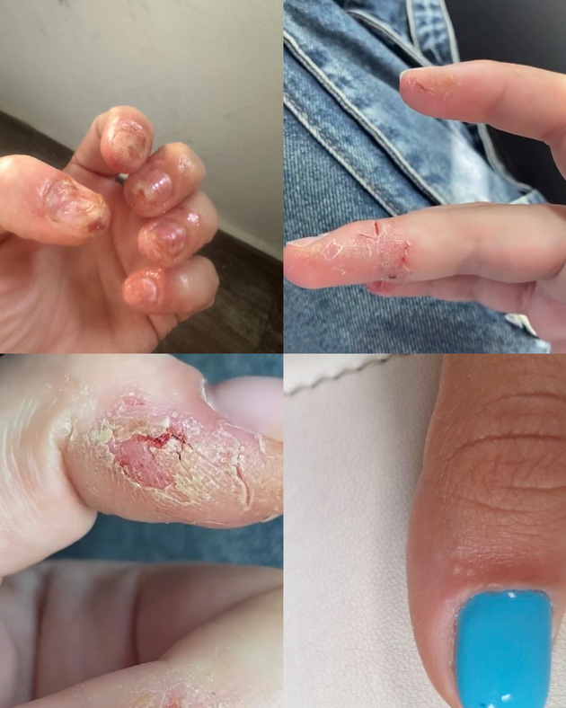 zgrozuvachka-scena-od-salon-za-manikir-vo-makedonija-tehnicharka-za-nokti-so-apel-opasno-e-ako-vi-se-pojavi-alergija-na-gelovite-04.jpeg