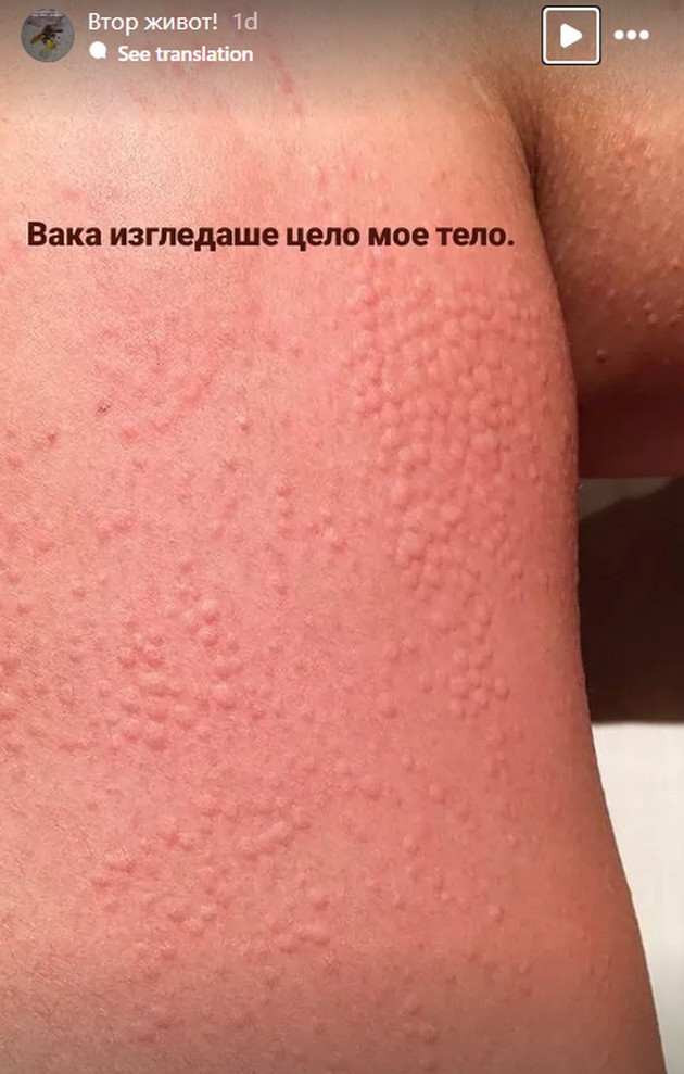 ledenata-makedonka-betika-spodeli-strashno-iskustvo-i-fotki-od-bolnica-zgaznav-na-strshlen-izbegnav-sigurna-smrt-04.jpg