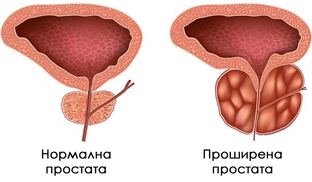 dali-site-mazhi-kje-imaat-zgolemena-prostata-koi-se-simptomite-03.jpg