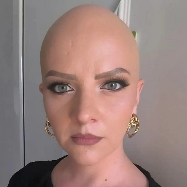 kristina-andova-za-bitkata-so-alopecija-nikogash-nema-da-nosam-marami-sega-koga-ja-znam-slobodata-bez-niv-11.JPG