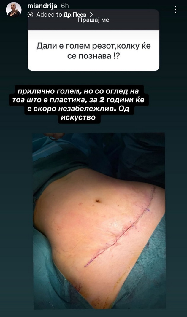 mia-kostova-napravi-liposukcija-na-stomakot-bev-budna-vo-tekot-na-operacijata-me-chineshe-okolu-1500-07.jpg