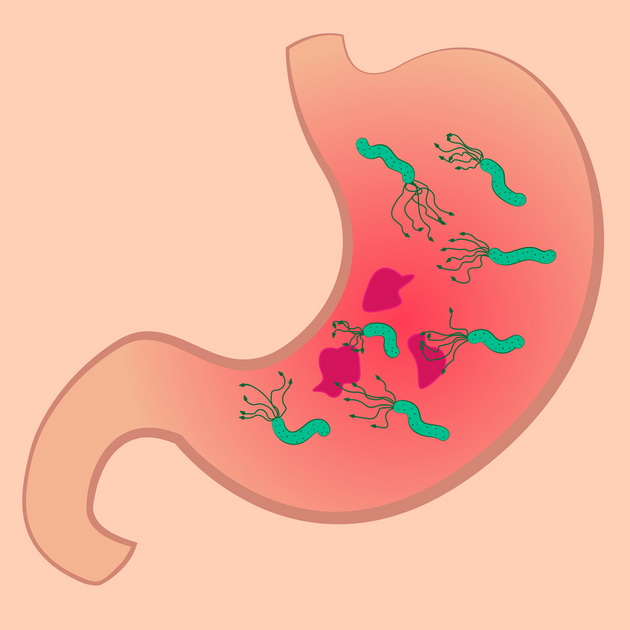 elena-curakova-ristovska-gastroenterohepatolog-helikobakter-pilori-simptomi-kako-se-lekuva-i-kakvi-komplikacii-predizvikuva-04.jpg
