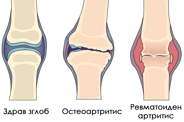 koi-se-najchestite-vidovi-artritis-i-koi-simptomi-se-javuvaat-prvi-02.jpg