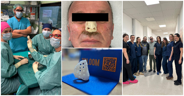 prvpat-vo-makedonija-ispechaten-3d-implant-za-nos-pacientot-go-zagubil-nosot-od-maligna-bolest-01.jpg