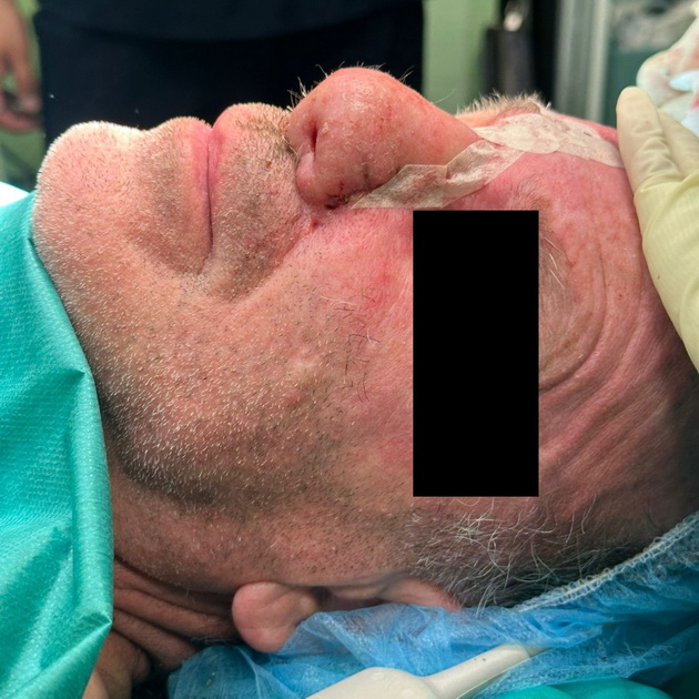 prvpat-vo-makedonija-ispechaten-3d-implant-za-nos-pacientot-go-zagubil-nosot-od-maligna-bolest-05.jpg