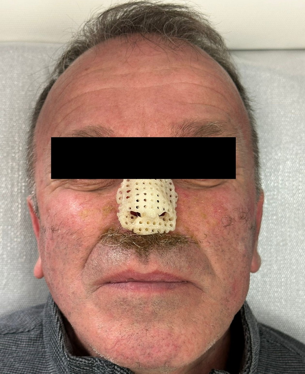 prvpat-vo-makedonija-ispechaten-3d-implant-za-nos-pacientot-go-zagubil-nosot-od-maligna-bolest-06.jpg