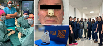 prvpat-vo-makedonija-ispechaten-3d-implant-za-nos-pacientot-go-zagubil-nosot-od-maligna-bolest-poveke-01.jpg