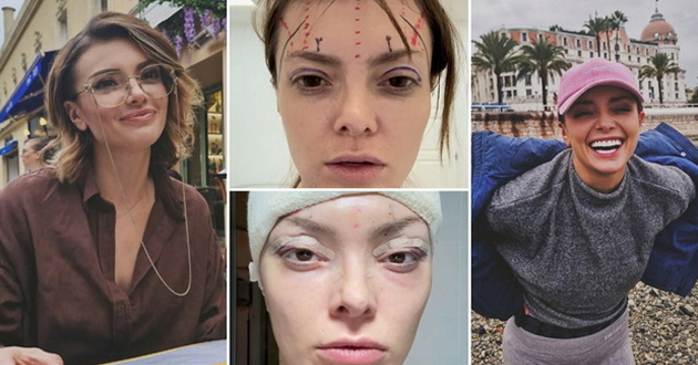 ela-dvornik-objavi-voznemiruvachki-fotografii-po-plastichnata-operacija-na-liceto-sakala-da-ne-izgleda-umorno-01.jpg