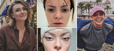 ela-dvornik-objavi-voznemiruvachki-fotografii-po-plastichnata-operacija-na-liceto-sakala-da-ne-izgleda-umorno-01povekje.jpg